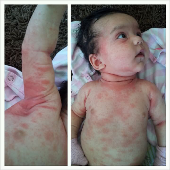 Update on eczema babies? Pic BabyCenter